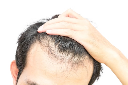 Homem que sabe o que é dermatite seborreica e está passando por quedas de cabelo