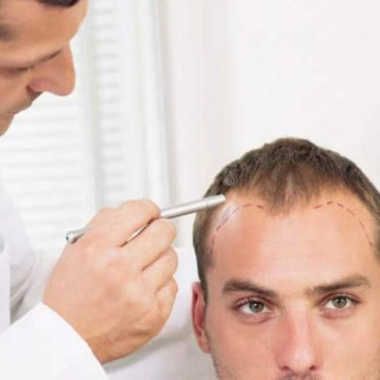 Homem sendo examinado após ter dúvidas de como fazer implante de cabelo