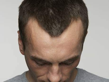Homem com entradas no couro cabeludo e pensando em pesquisar em implante capilar valor 